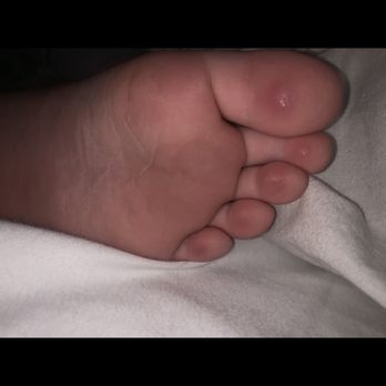 CoCo Key - Every toe is cut and blistered from pool floor - Resorts Near Me - Orlando, Florida CoCo Key - Every toe is cut and blistered from pool floor - Resorts Near Me - Orlando, Florida