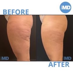 Skin MD - Tighter, smoother, more lifted skin with Morpheus8. A powerful RF microneedling treatment for face & body rejuvenation.