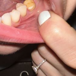 Sharmilla Anand - Shaved tooth (flat) after permanent crown fell out after only 11 days.