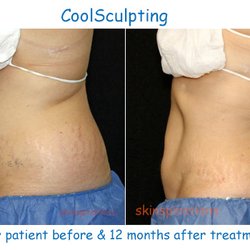 Skinspirations - Our before & after results with nonsurgical body contouring and fat reduction