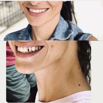 Mamut Dentistry - These are my teeth before / after fixing. - Cosmetic Dentists Near Me - Astoria, New York Mamut Dentistry - These are my teeth before / after fixing. - Cosmetic Dentists Near Me - Astoria, New York