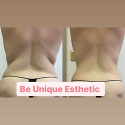 Be Unique Esthetic - Body sculpting (back)
