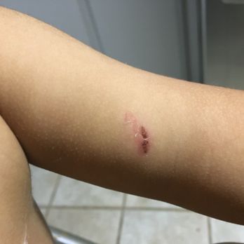 Beyond Montessori School - Bite that occurred at Beyond Montessori - Preschools Near Me - Dublin, California