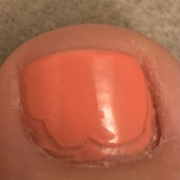Bad pedicure