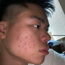 Bespoke Wellness & Acupuncture - Before treatment (lots of inflammation, cystic acne, redness)