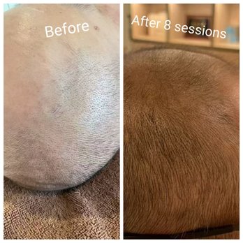 New Bliss Beauty Toudaotang 头道汤 - Severe hair loss, after 8 sessions which is 8 months using Lumenis Laser Hair Loss Treatment, the hair follicles are coming back. - Day Spas Near Me - New York, New York New Bliss Beauty Toudaotang 头道汤 - Severe hair loss, after 8 sessions which is 8 months using Lumenis Laser Hair Loss Treatment, the hair follicles are coming back. - Day Spas Near Me - New York, New York