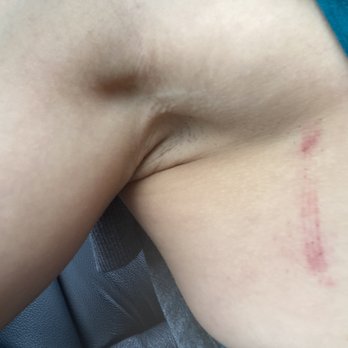 Exclusively You - One of the many marks from my dress after having it on for mere minutes at a time after alterations. - Bridal Near Me - Bloomsburg, Pennsylvania