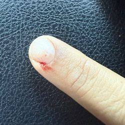 Sussex Nails - Injured finger- by Dana. She was going to apply glue to stop the bleeding!