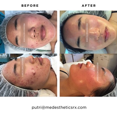 Acne - Before & After - As seen on Good Morning America, MedEstheticsRx is a results-oriented aesthetic practice dedicated to the science of the body’s largest organ—the skin. Using proven techniques like dermaplaning, microdermabrasion, and microneedling, our California State licensed Estheticians use the world’s most effective skincare modalities and the latest anti-aging treatments to achieve dramatic and long-lasting results that will keep you looking your youngest and best self `for decades to come. Give us one visit and you’ll see a difference. Acne - Before & After - As seen on Good Morning America, MedEstheticsRx is a results-oriented aesthetic practice dedicated to the science of the body’s largest organ—the skin. Using proven techniques like dermaplaning, microdermabrasion, and microneedling, our California State licensed Estheticians use the world’s most effective skincare modalities and the latest anti-aging treatments to achieve dramatic and long-lasting results that will keep you looking your youngest and best self `for decades to come. Give us one visit and you’ll see a difference.