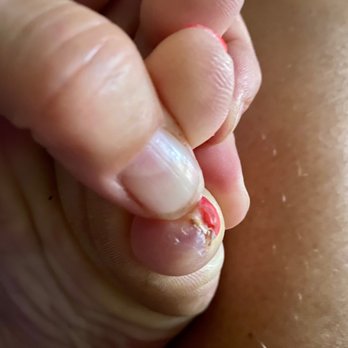 Bella Nail Spa - 9/9, now 20 days since the pedicure. Sorry for the disgustingness. - Nail Salons Near Me - San Ramon, California Bella Nail Spa - 9/9, now 20 days since the pedicure. Sorry for the disgustingness. - Nail Salons Near Me - San Ramon, California