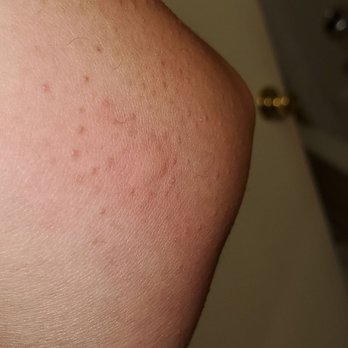 Comfort Inn Yosemite Area - Another bed bug bite - Hotels Near Me - Oakhurst, California Comfort Inn Yosemite Area - Another bed bug bite - Hotels Near Me - Oakhurst, California