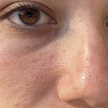 Fresh Face Skin Lab - Deep pore cleaning - Skin Care Near Me - Emeryville , California
