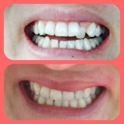 Walnut Street Family Dentistry - Dr. Ericks is an awesome dentist! He turned my smile into perfection in my eyes! very pleased with the outcome!