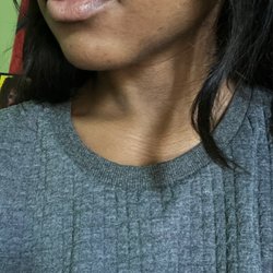 Simply Injectables - Side view 2 weeks after injections