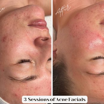 Dolce Aesthetics - ACNE FACIAL - Eyebrow Services Near Me - Beverly Hills, California Dolce Aesthetics - ACNE FACIAL - Eyebrow Services Near Me - Beverly Hills, California
