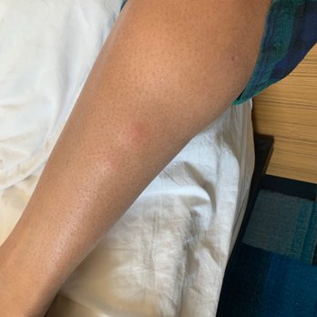 Aloft by Marriott Broomfield Denver - Bed bug bites on my daughter. Told a day AFTER check in that no turn down service for 5 days. They re-used the same sheets on day 5 - Hotels Near Me - Broomfield, Colorado Aloft by Marriott Broomfield Denver - Bed bug bites on my daughter. Told a day AFTER check in that no turn down service for 5 days. They re-used the same sheets on day 5 - Hotels Near Me - Broomfield, Colorado