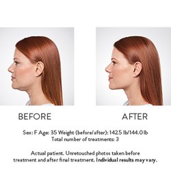 Newport Aesthetics - Kybella treats double chin, jowls and neck laxity associated with age.
