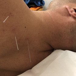 Chen's Chinese Medicine - 5 acupuncture sites for unilateral neck & shoulder pain that wouldn't go away.  3 sessions later, 100% relief  :)