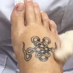 North Texas Podiatry Associates - Before surgery