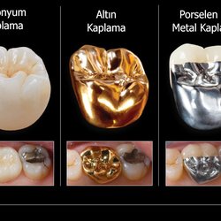 Dentalis - Protez Diş Tedavi Yöntemleri http://www.dentalisklinik.com