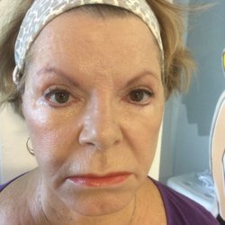 R5 Skinworks - After Purifying Facial