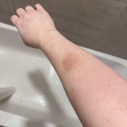 Hand & Stone Massage and Facial Spa - Bruises left on both arms