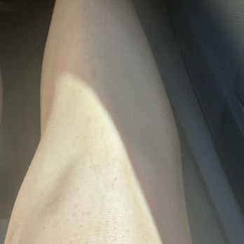 LaserAway - Laser Hair Removal Near Me - Scottsdale, Arizona