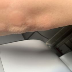 Wyndham Stuttgart Airport Messe - Bed bug bites marks from this hotel after staying there one night before departure