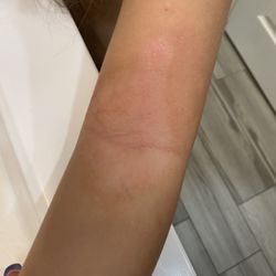 Happy Skin Pediatric Dermatology - After 2 weeks