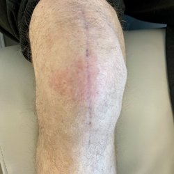 Colorado Joint Replacement