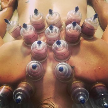 Dynamic Wellness - Cupping - Massage Therapy Near Me - Bakersfield, California Dynamic Wellness - Cupping - Massage Therapy Near Me - Bakersfield, California
