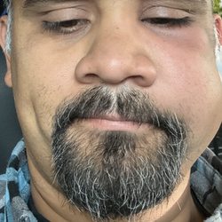 Brentwood Fairview Dental - Infection in two teeth.