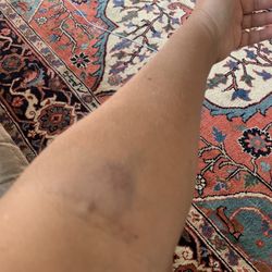 Palisades Medical Center - When you have the worse veins for a line