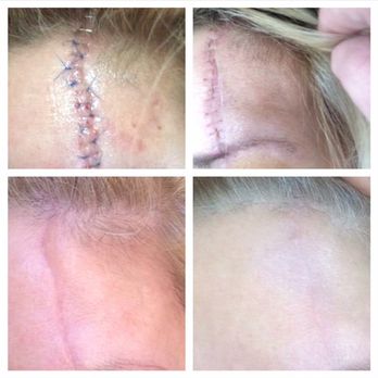 Skinrosse Spa - Tratamiento para cicatrices o marcas de acce - Day Spas Near Me - Houston, Texas Skinrosse Spa - Tratamiento para cicatrices o marcas de acce - Day Spas Near Me - Houston, Texas