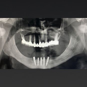 Pristine Oral & Maxillofacial Surgery - Same day "Teeth ". Patient had implants placed and crowns same day in lower jaw. - Oral Surgeons Near Me - Brooklyn, New York Pristine Oral & Maxillofacial Surgery - Same day "Teeth ". Patient had implants placed and crowns same day in lower jaw. - Oral Surgeons Near Me - Brooklyn, New York