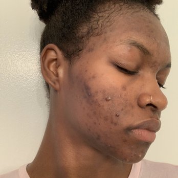 Az Skin Rehab - Before Treatment - Day Spas Near Me - Chandler, Arizona