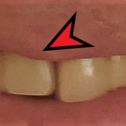Alamogordo Dental Group - Added tooth looks like I need braces now.
