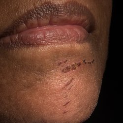 Diva Nail Salon - Scarring from chin waxing. Diva Salon September 25, 2026