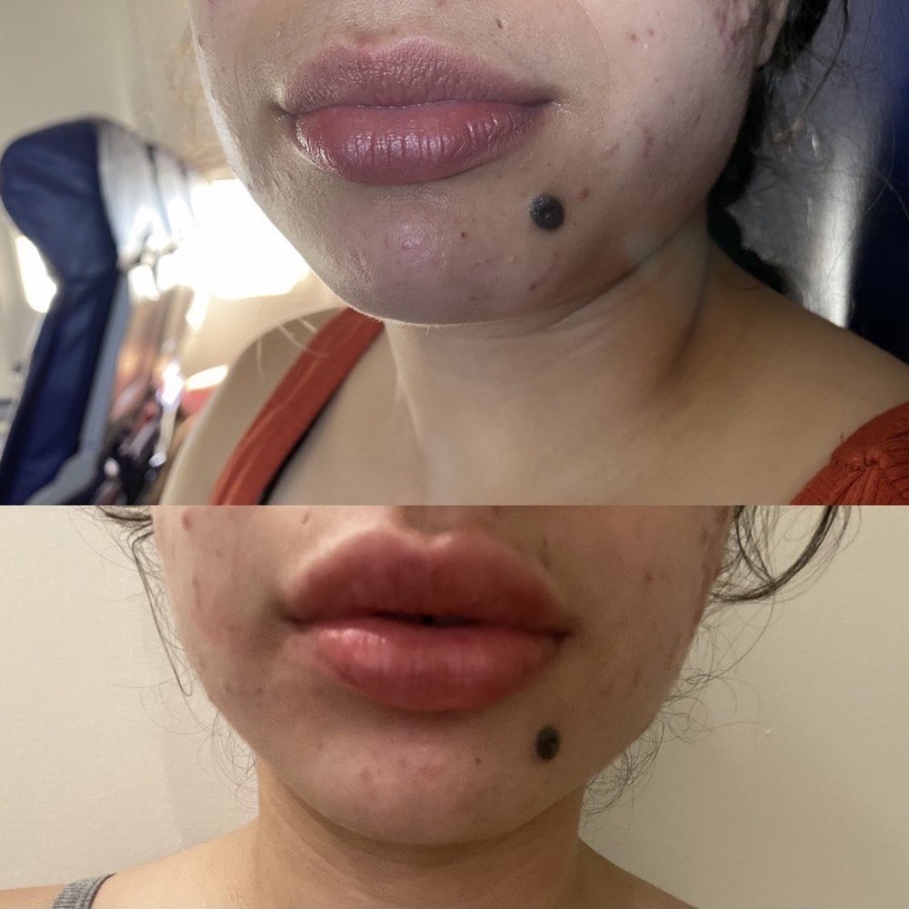 Sculpt - Before and after of my lips - Medical Spas Near Me - Los Angeles, California