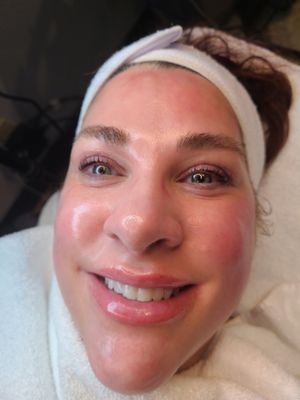 Hydrafacials (Specialty) - Hydrafacial for the win! Hydrafacials offer non-invasive skin resurfacing treatment. It combines cleansing, exfoliation, extraction, hydration and antioxidant protection that removes dead skin cells and impurities, while simultaneously delivering moisturizing serums into the skin. Get Same/ Next Day service or same week appointments with budget friendly prices! Hydrafacials (Specialty) - Hydrafacial for the win! Hydrafacials offer non-invasive skin resurfacing treatment. It combines cleansing, exfoliation, extraction, hydration and antioxidant protection that removes dead skin cells and impurities, while simultaneously delivering moisturizing serums into the skin. Get Same/ Next Day service or same week appointments with budget friendly prices!