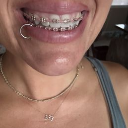 Good (braces) brackets with the pink rubber bands the best combo! Good (braces) brackets with the pink rubber bands the best combo!