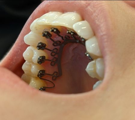 Lingual Braces - Lingual braces are an excellent option for patients who are focused on an aesthetic orthodontic treatment option, and want to avoid the challenges associated with clear aligners. Unlike traditional braces, lingual braces are hidden from view. They are also extremely effective at correcting the alignment of teeth and the bite. Lingual braces vs traditional braces – which would you choose?

https://porth.io/education-hub/what-are-lingual-braces/