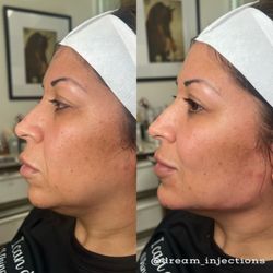 Dream Aesthetics Medspa - Jawline filler