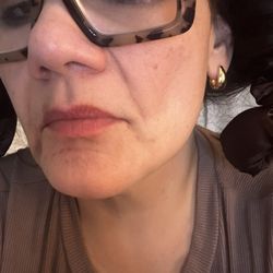 Ariava Brows & Beauty - Filler bruised