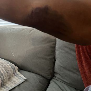 Sweet James Accident Attorneys - Bruising from accident - Personal Injury Law Near Me - Ontario, California