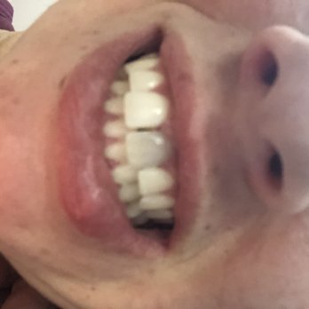 Advanced Care In Endodontics - Before bleaching - Endodontists Near Me - Buffalo Grove, Illinois Advanced Care In Endodontics - Before bleaching - Endodontists Near Me - Buffalo Grove, Illinois