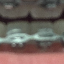 Danel Jeremiah K, DDS - You can clearly see how they didn't do the 2 bottoms very sad