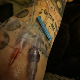 This is my arm at home with the IV still in it. This is my arm at home with the IV still in it.