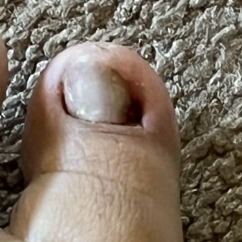 Long Nails & Spa - Damaged toe during pedicure. - Nail Salons Near Me - Hayward, California Long Nails & Spa - Damaged toe during pedicure. - Nail Salons Near Me - Hayward, California