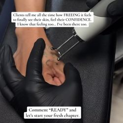Un-Ink'd by Marisabel - Laser Tattoo Removal